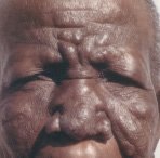 Comprometimento facial avançado com colapso da cartilagem nasal